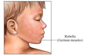 Rubella german measles