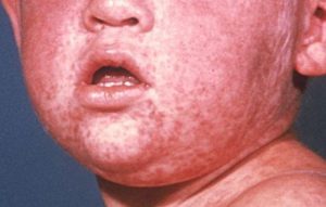 measles image face