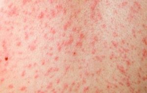 measles photo