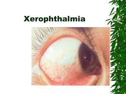 xerophthalmia