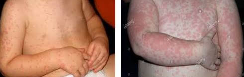Amoxicillin rash pictures 4