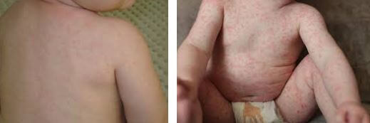 Amoxicillin rash pictures 7