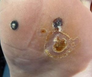 plantar-warts-pictures-9