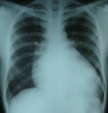 Cardiomegaly X-Ray