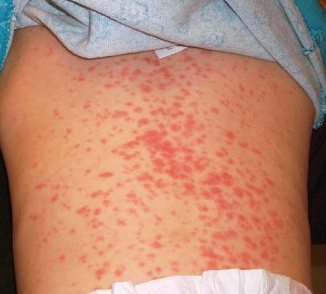 amoxicillin rash pictures 2