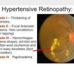 Hypertensive Retinopathy