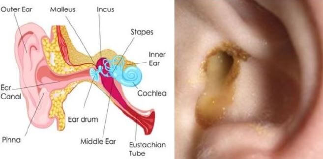 Drainage from external ear