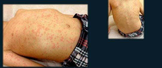 Amoxicillin Rash - Pictures, Adults, Baby, Types, Treatment, Prevention